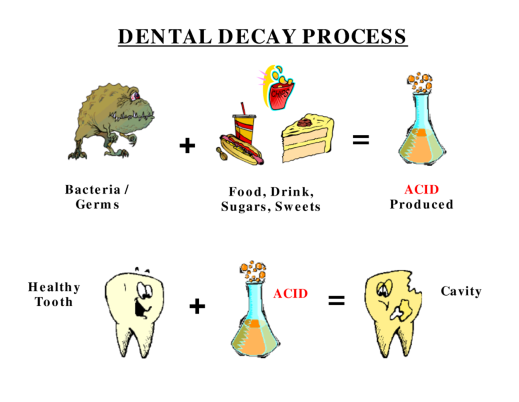 dental decay process diagram