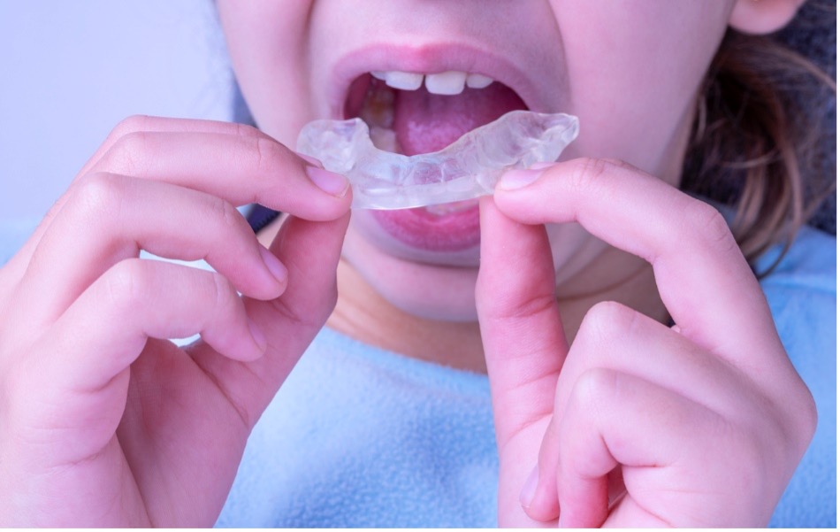 Young person putting clear mouthguard into mouth