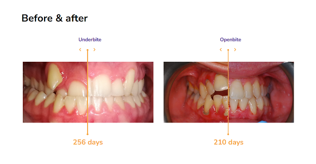 A collage of teeth and gums, before and after fastbraces
