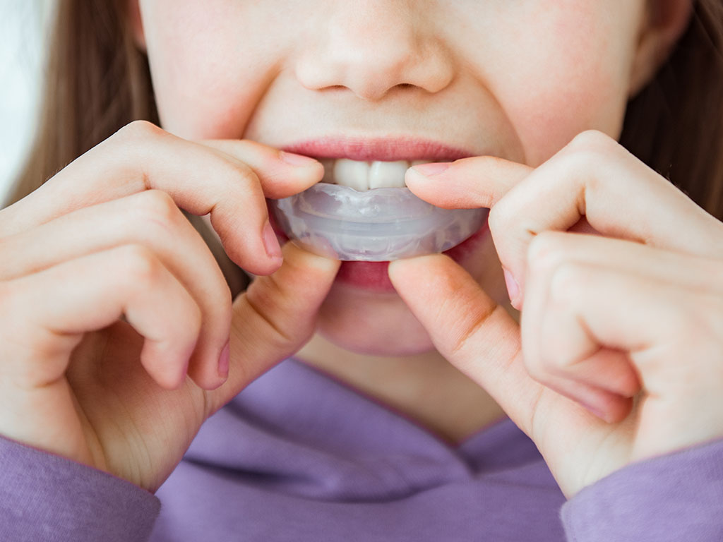 Protection, Prevention, and Treatment - How Mouth Guards Actually Work